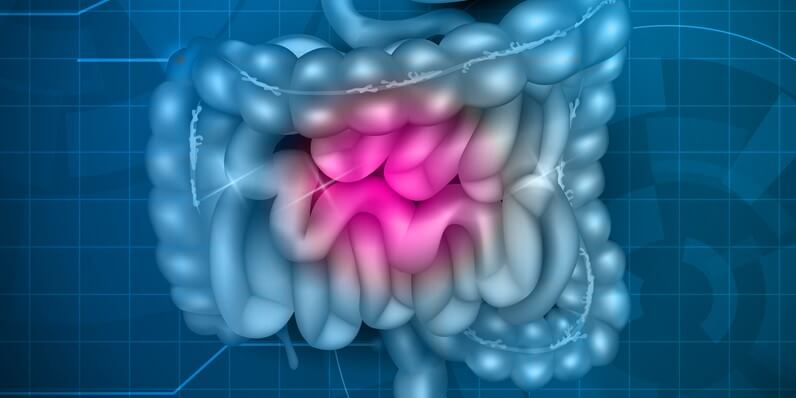 ulcerative colitis