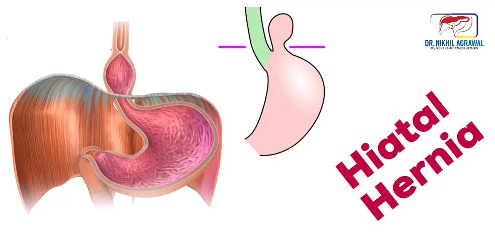 Hiatus Hernia