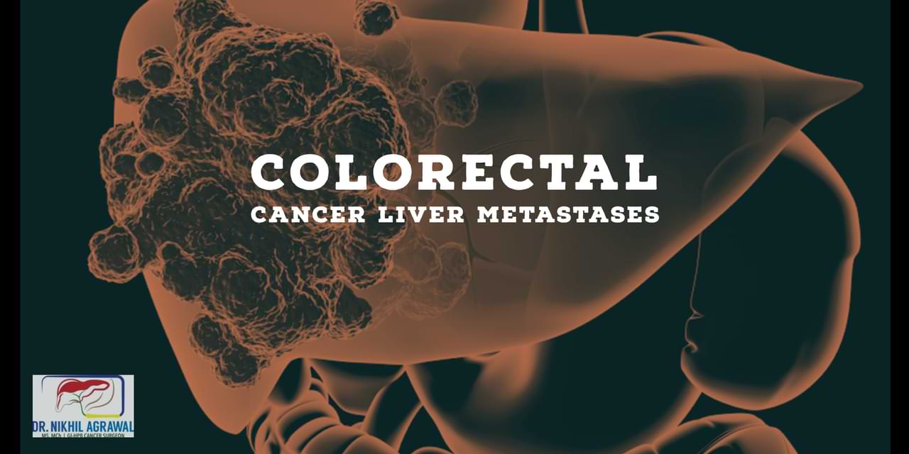 Colon and Rectal Cancer with Liver Metastases