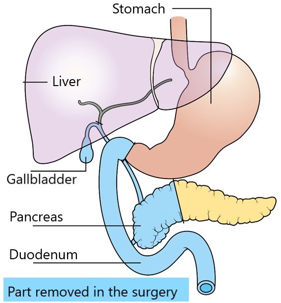 Whipple Procedure Pancreatic Cancer Treatment Dr Nikhil Agrawal Whipple Procedure Pancreatic Cancer Treatment Dr Nikhil Agrawal