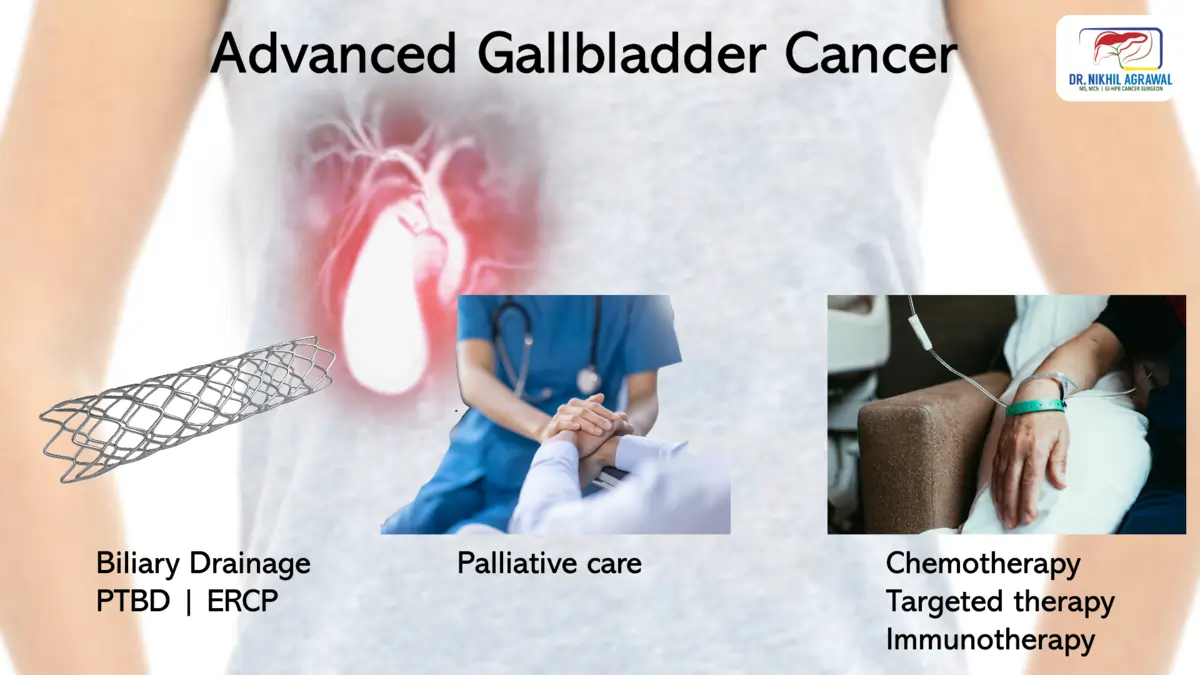How is advanced gallbladder cancer treated?