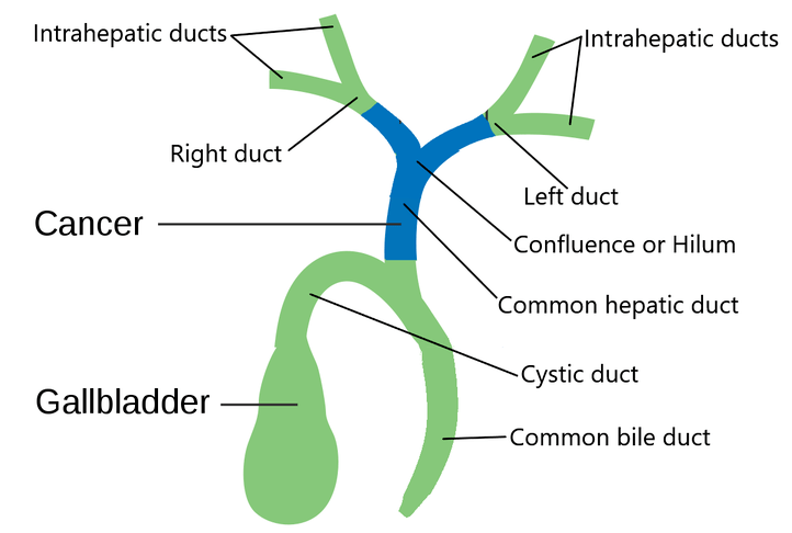 Bile duct anatomy, bile duct cancer