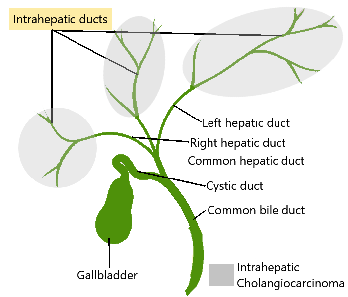  intrahepati Bile duct anatomy, intrahepatic bile duct cancer, intrahepatic cholangiocarcinoma