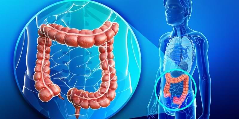 colon cancer