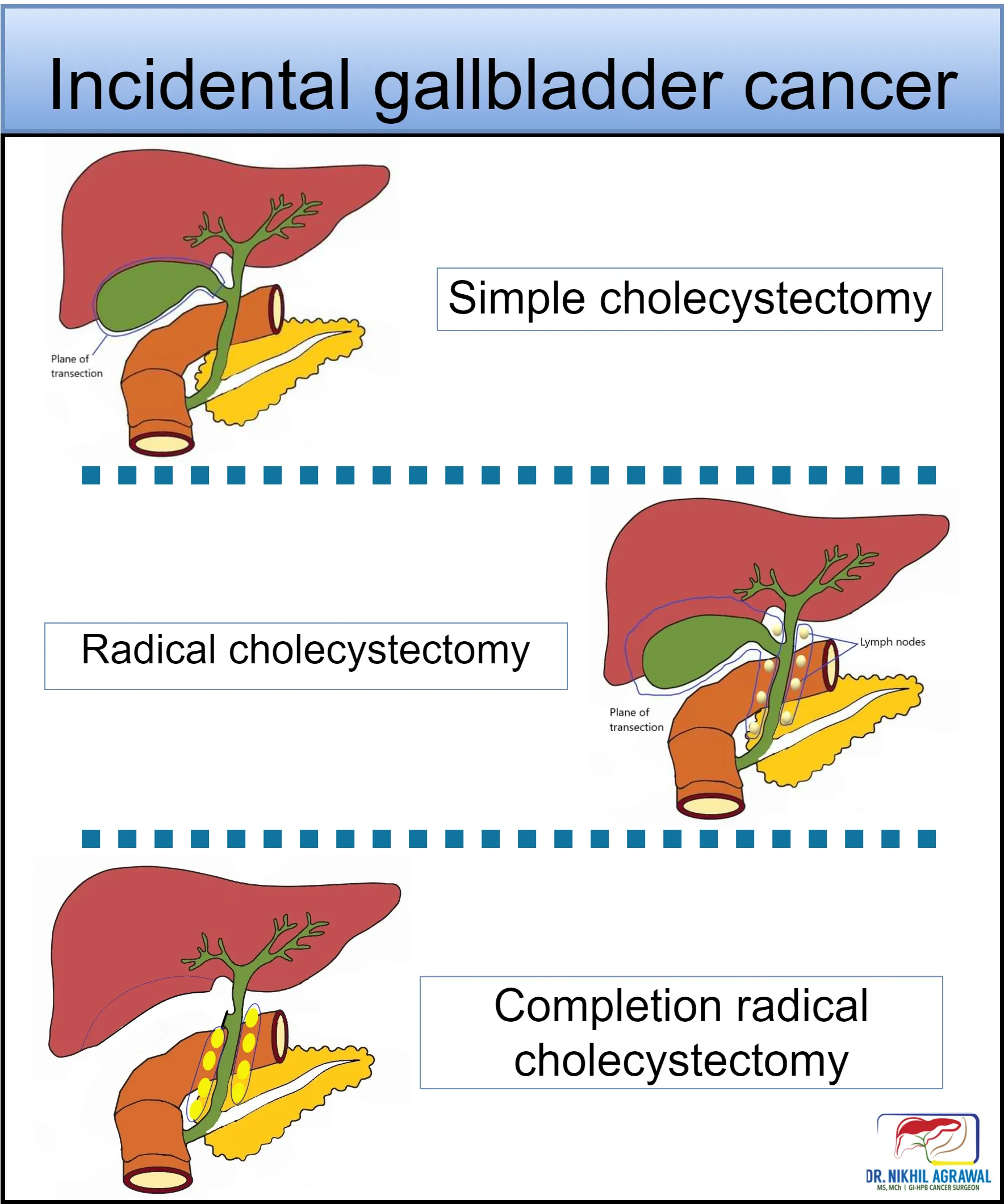 Types of gallbladder surgeries
