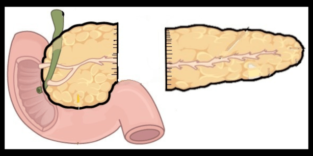 Distal pancreatectomy