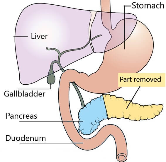 Distal pancreatectomy