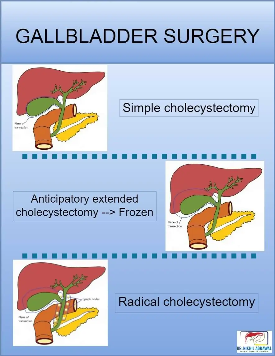 Gallbladder Surgery Types
