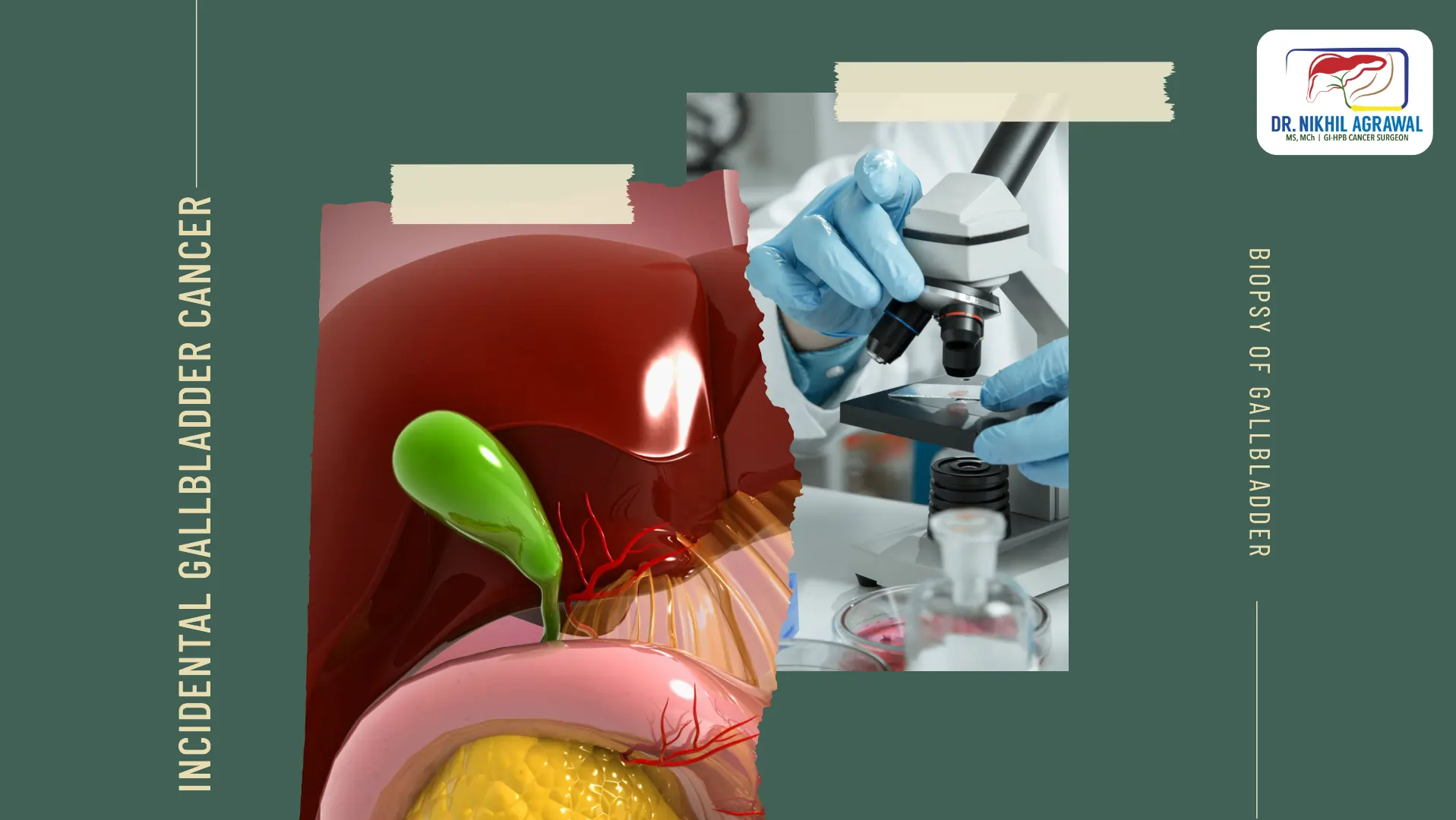 What is incidental gallbladder cancer?