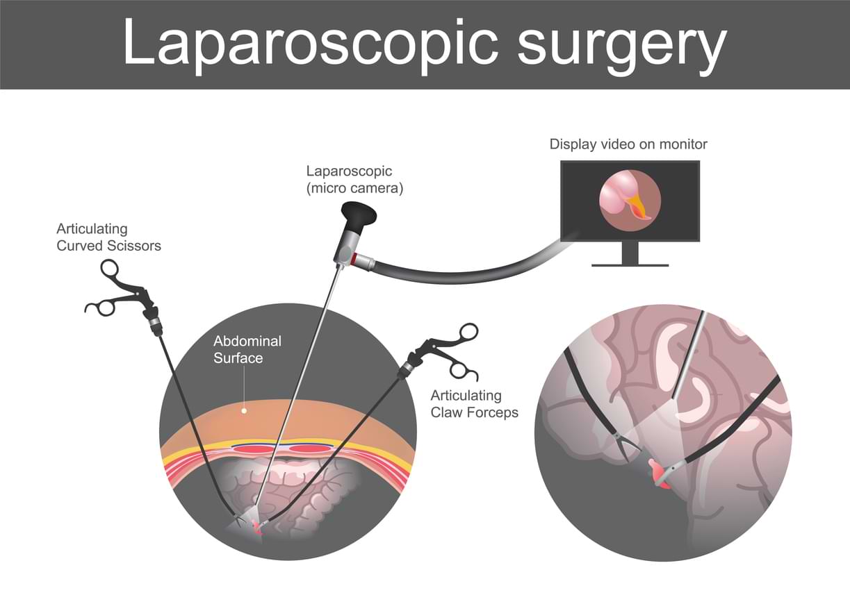 Best Laparoscopic Surgery in Delhi