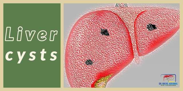liver cysts