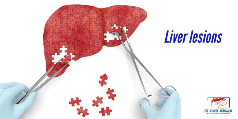Liver tumours, liver cysts and liver lesions