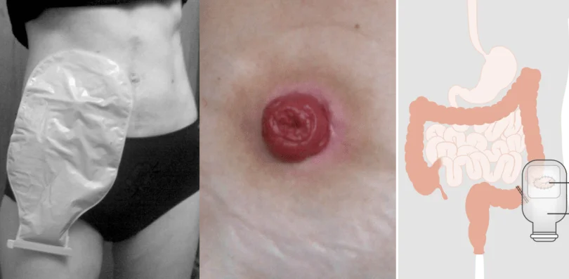 Ostomy (Ileostomy or Colostomy)