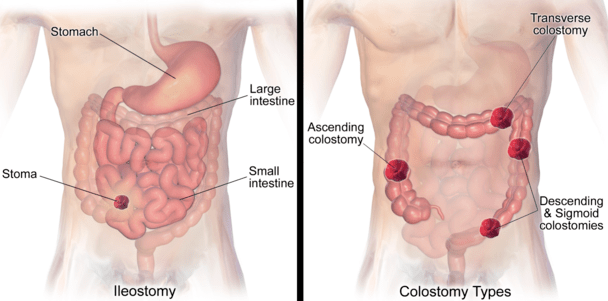 ileostomy or colostomy