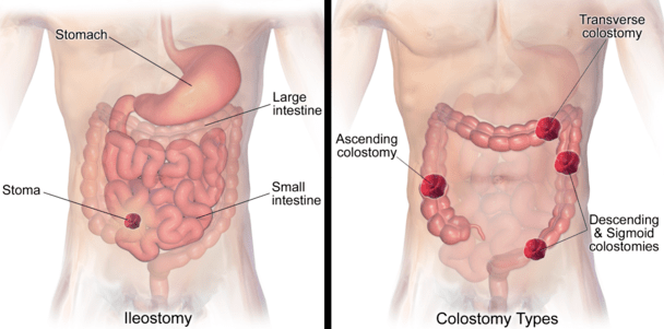 The Main Differences Between Ileostomy vs Colostomy Bag