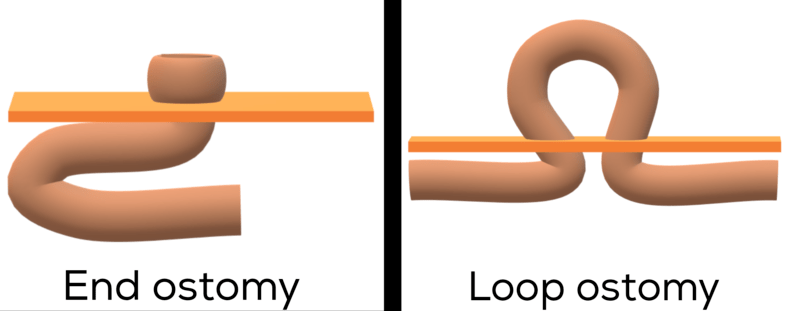 End vs loop ostomy (ileostomy or colostomy)