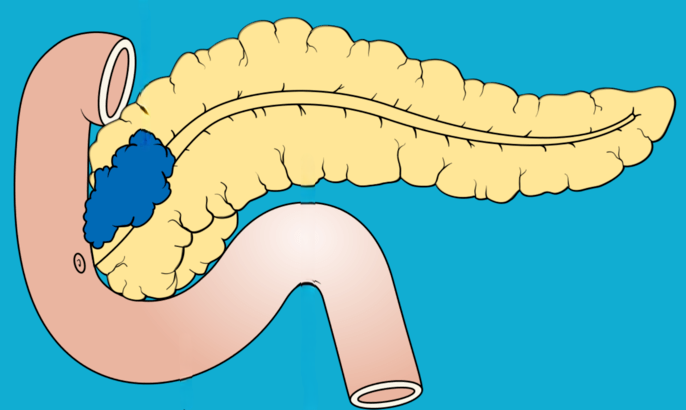 What is Pancreatic Cancer?