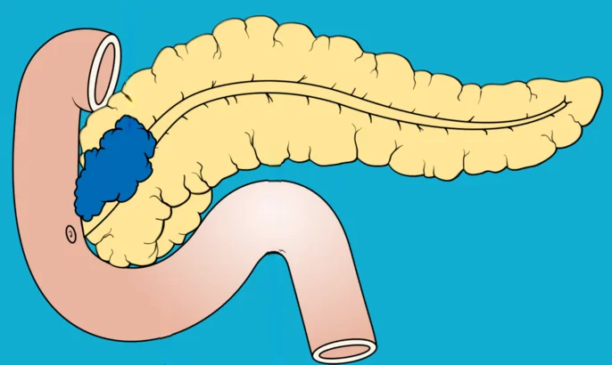 What is pancreatic cancer?