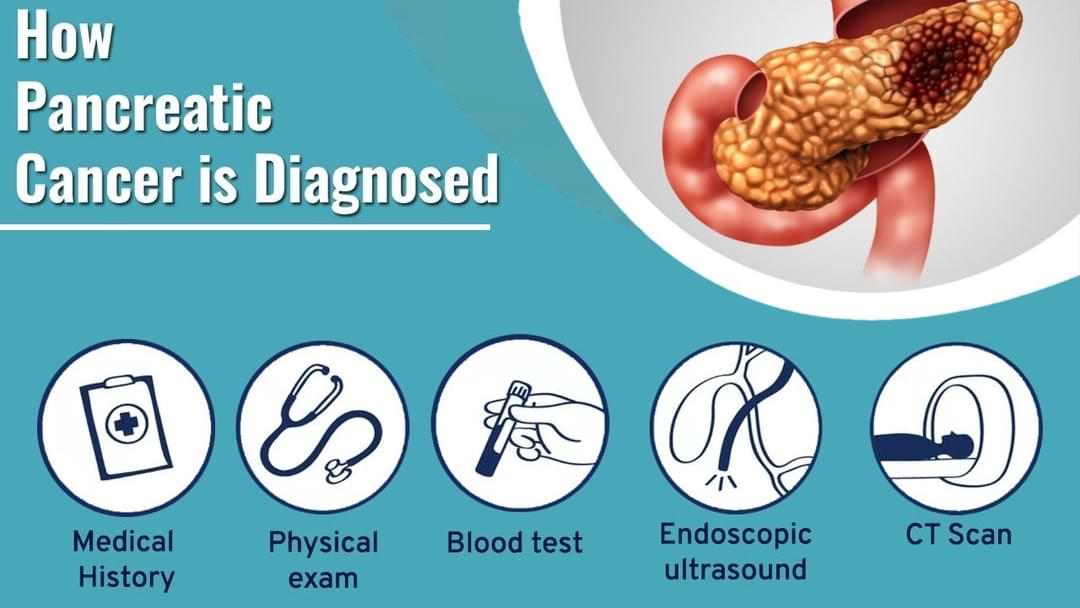 How is pancreatic cancer diagnosed?