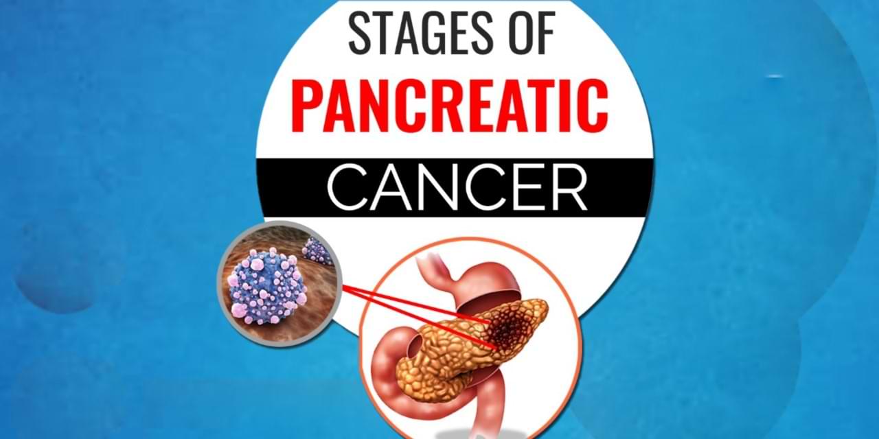 How is pancreatic cancer staged?