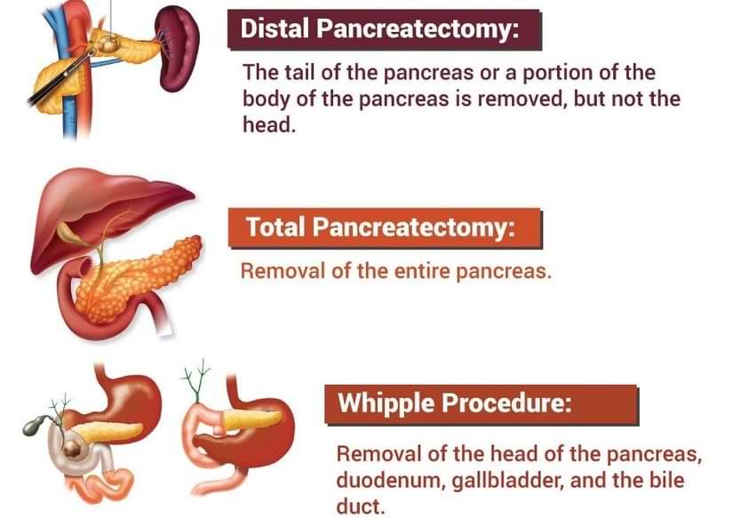 types of pancreatic cancer surgery