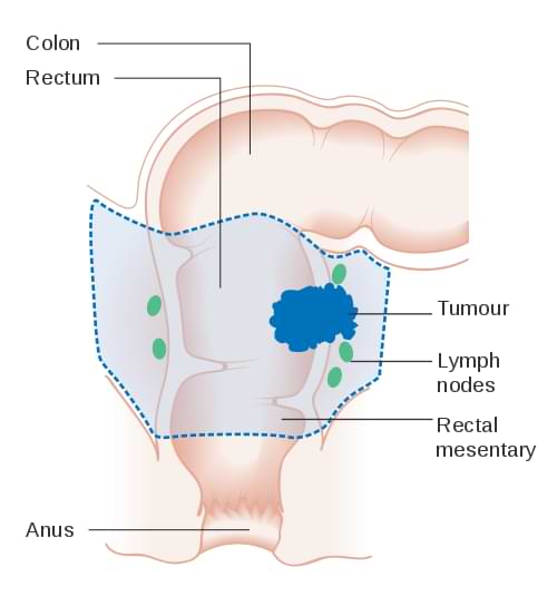 Area removed for rectal cancer