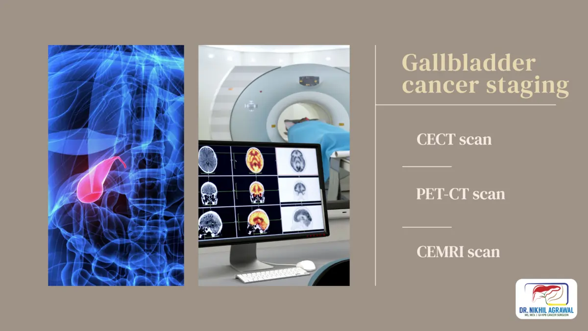 How gallbladder cancer is staged?