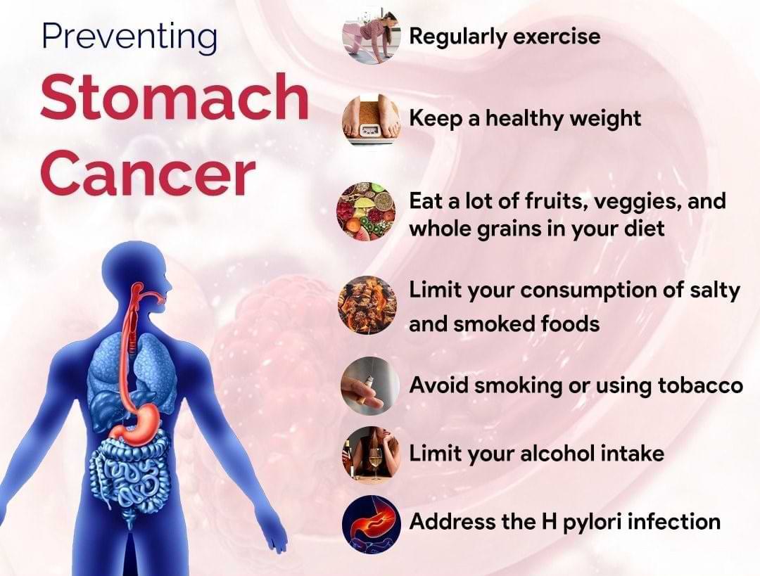How is stomach cancer prevention?