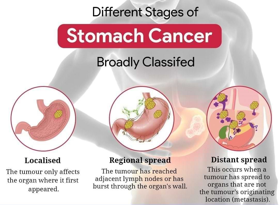 stomach cancer stages?