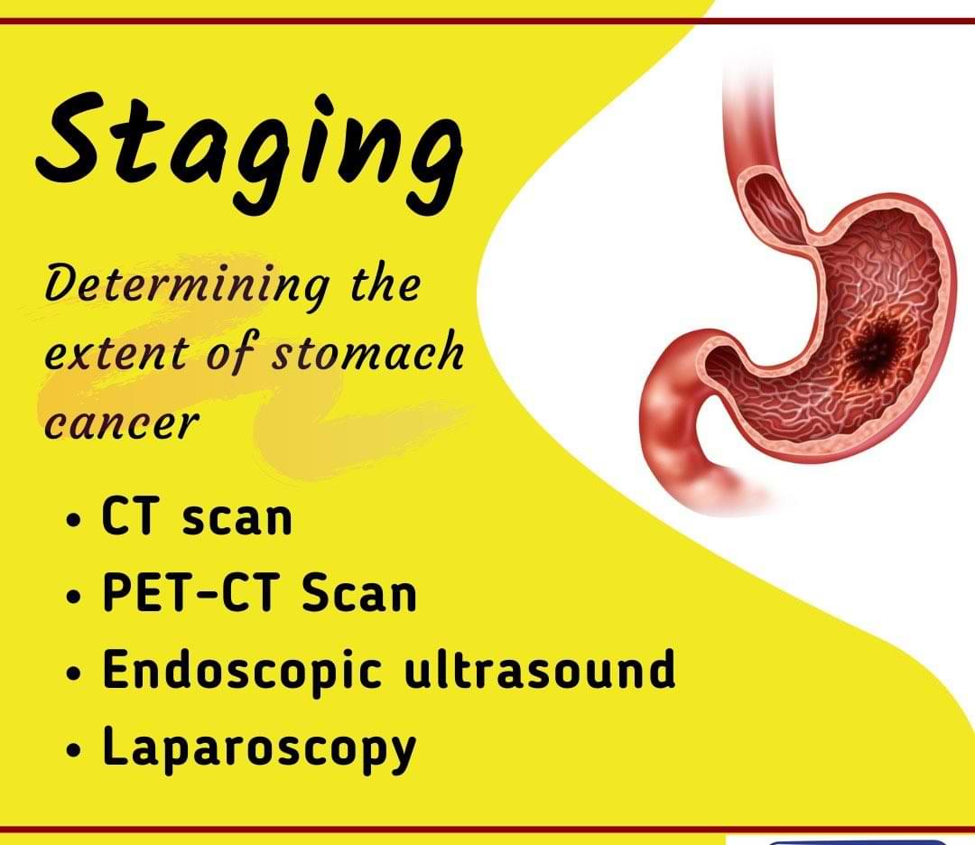 How is stomach cancer staged?