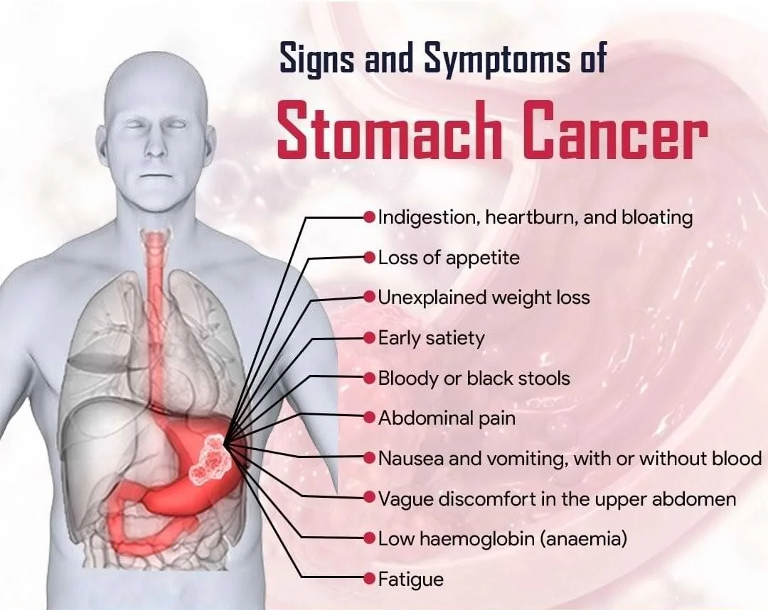 What are signs and symptoms of stomach cancer
