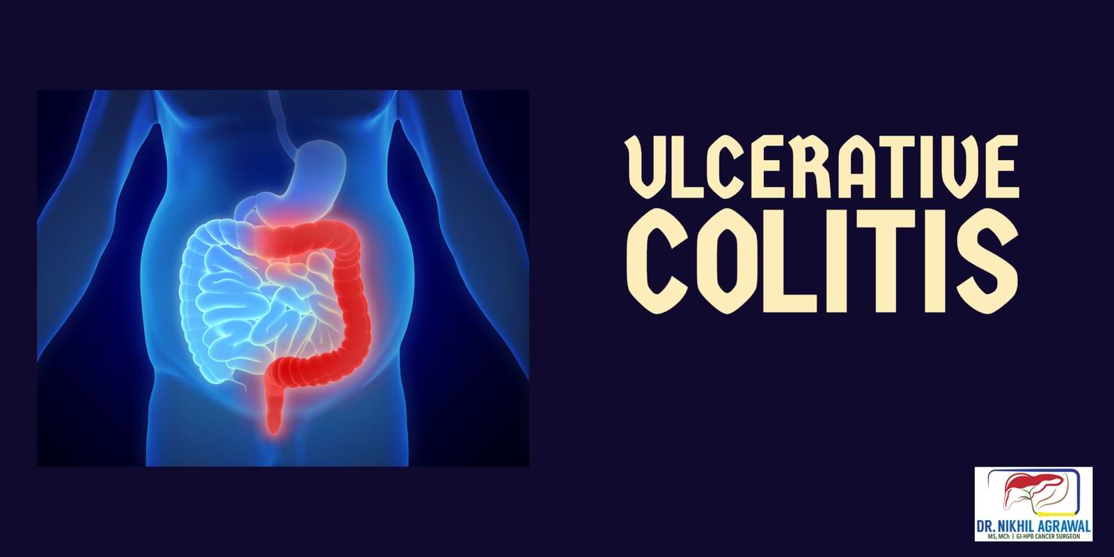 Ulcerative colitis and colorectal cancer