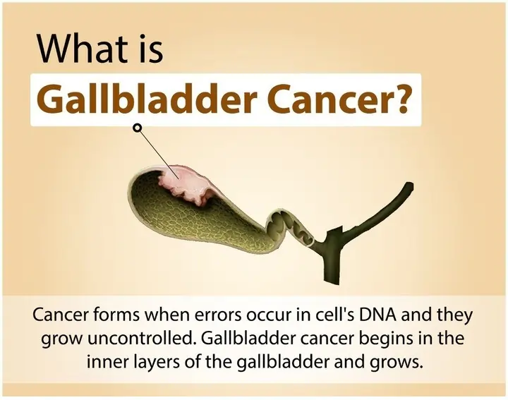 What is gallbladder cancer?