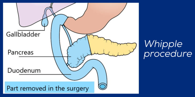 Whipple Procedure (pancreaticoduodenectomy)